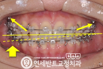 교정 장치 사진