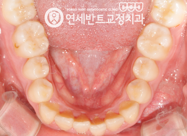아래 치열 사진
