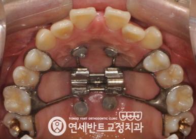 위턱 확장장치