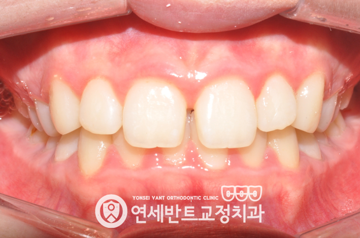 앞니 정면 사진