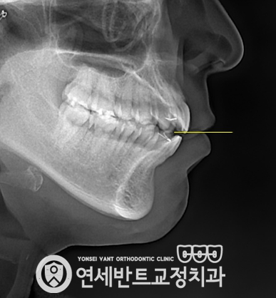 측면 X레이