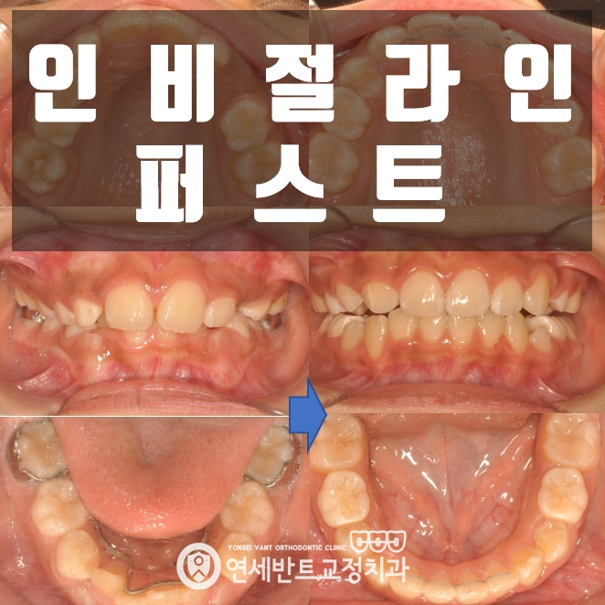 구월동 치아교정 — 인비절라인 퍼스트 소아 교정 과정은?