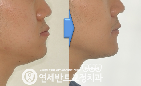옆모습 사진
