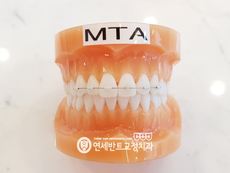 치아 모형 사진
