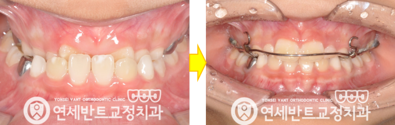 교정 전후 비교