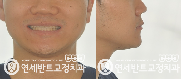 얼굴 정측면 컷
