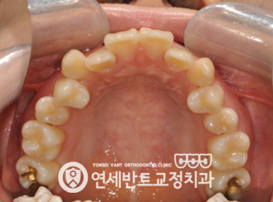 위 치열 사진