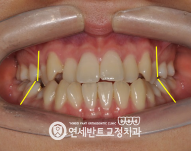 앞니 정면 사진
