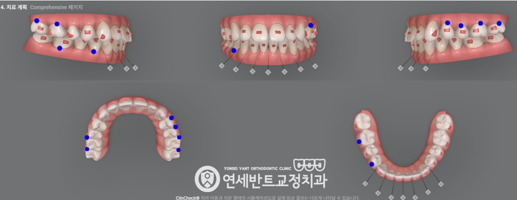 치아 3D 스캔