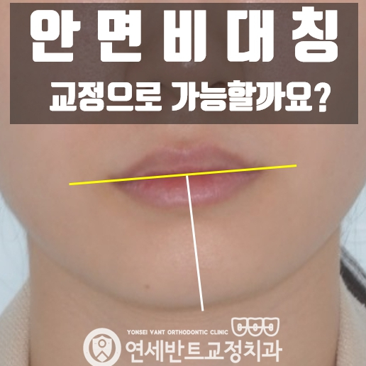 인천안면비대칭교정 치아교정으로 균형잡힌 얼굴