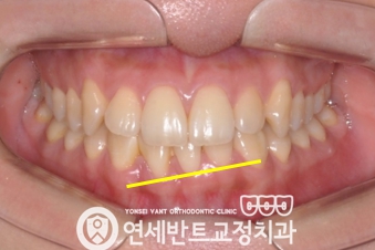 앞니 정면 사진