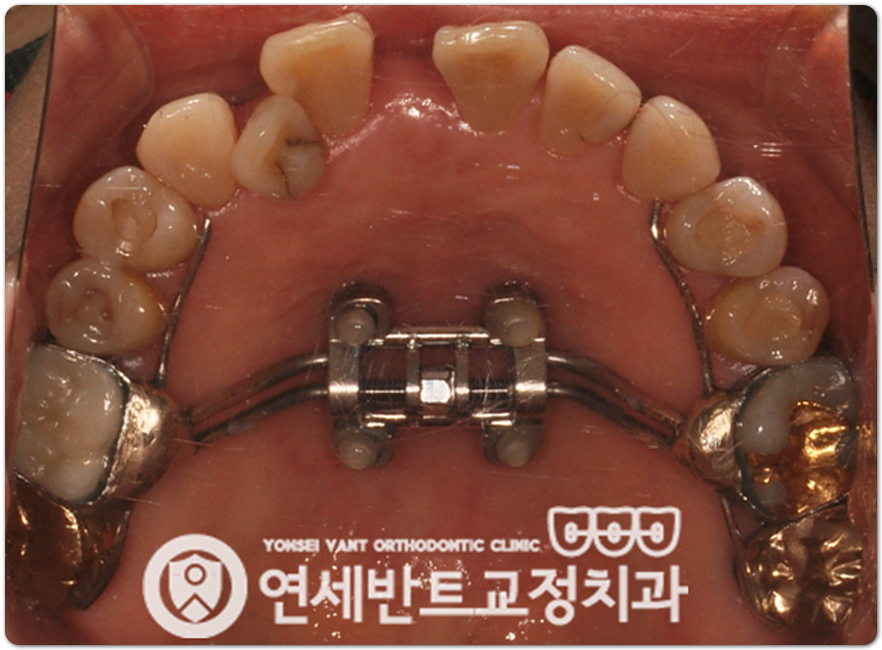위턱 확장장치