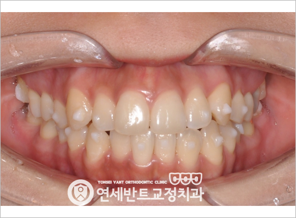 앞니 정면 사진