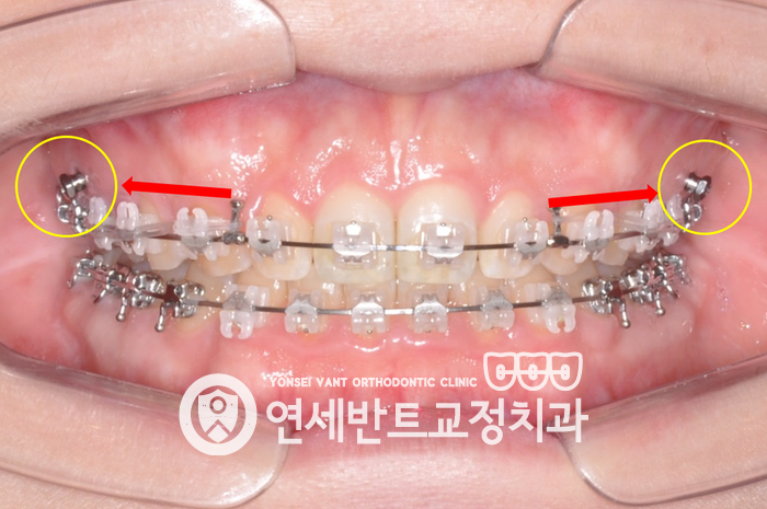교정 장치 사진