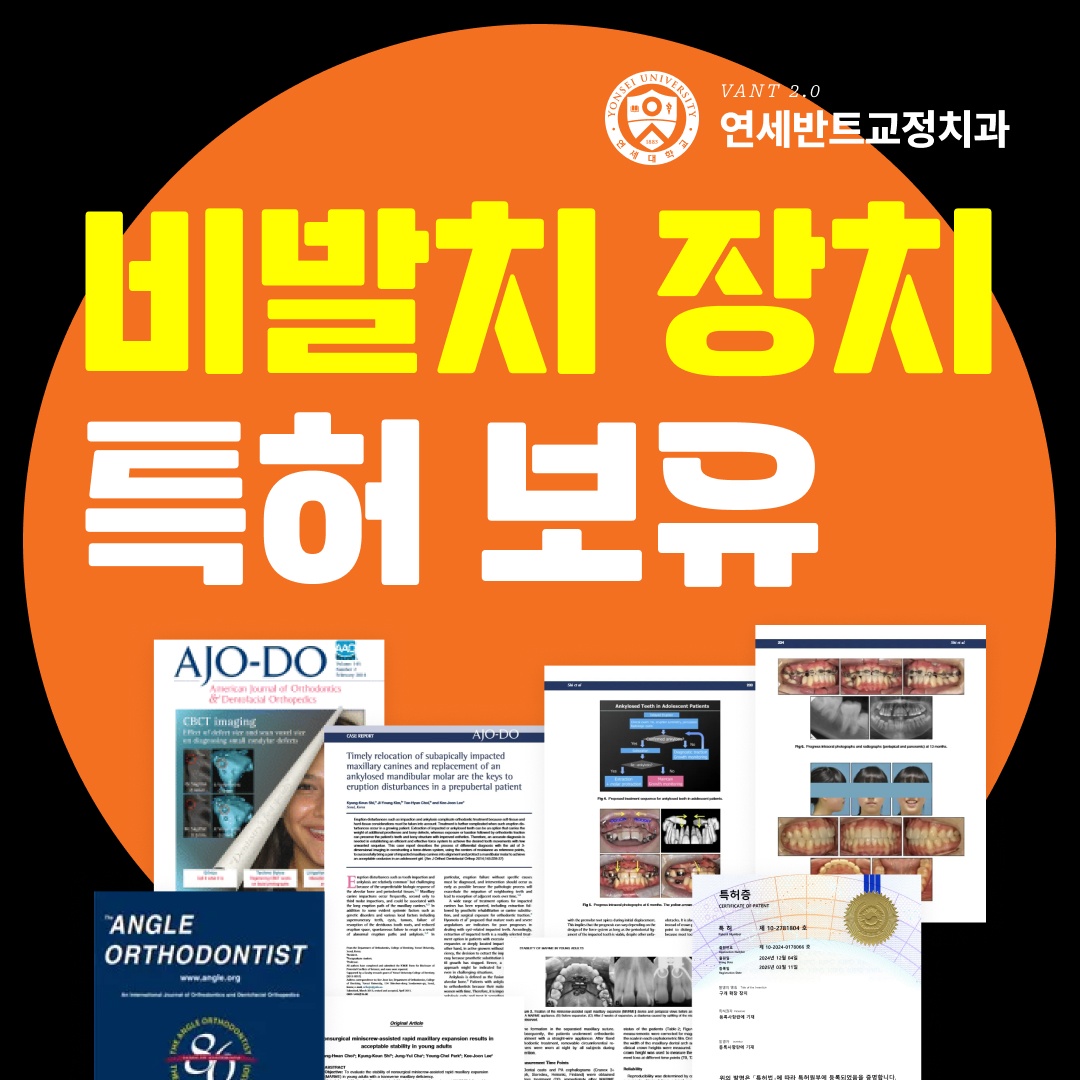 비발치 장치 안내