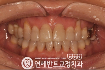 앞니 정면 사진