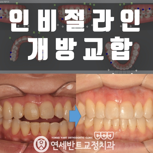 인천인비절라인 개방교합 고민 덜 수 있을까?