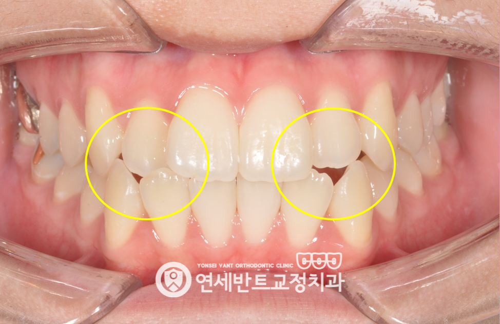 앞니 구강 사진