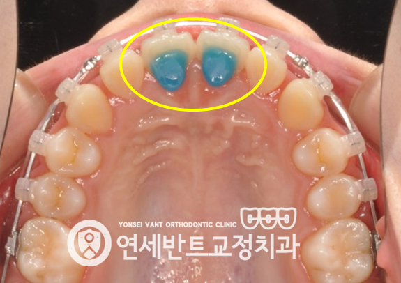 위턱 장치 사진