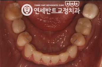 아래 치열 사진