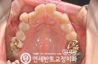 위 치열 사진