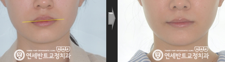 얼굴 전후 비교