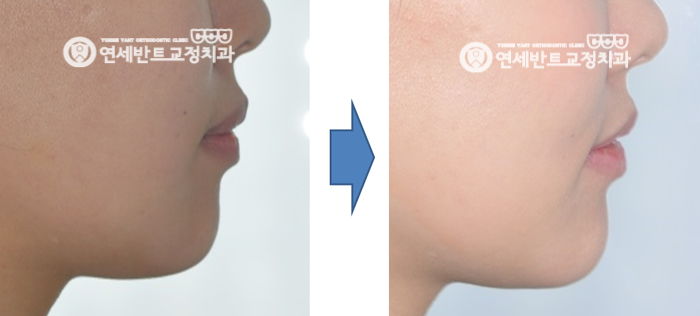 옆모습 전후 비교