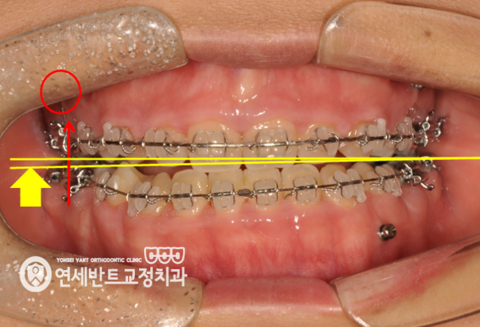 교정 장치 사진