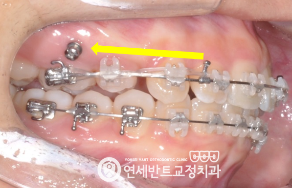 측면 장치 사진