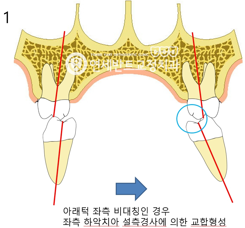 아래턱 비대칭 도해