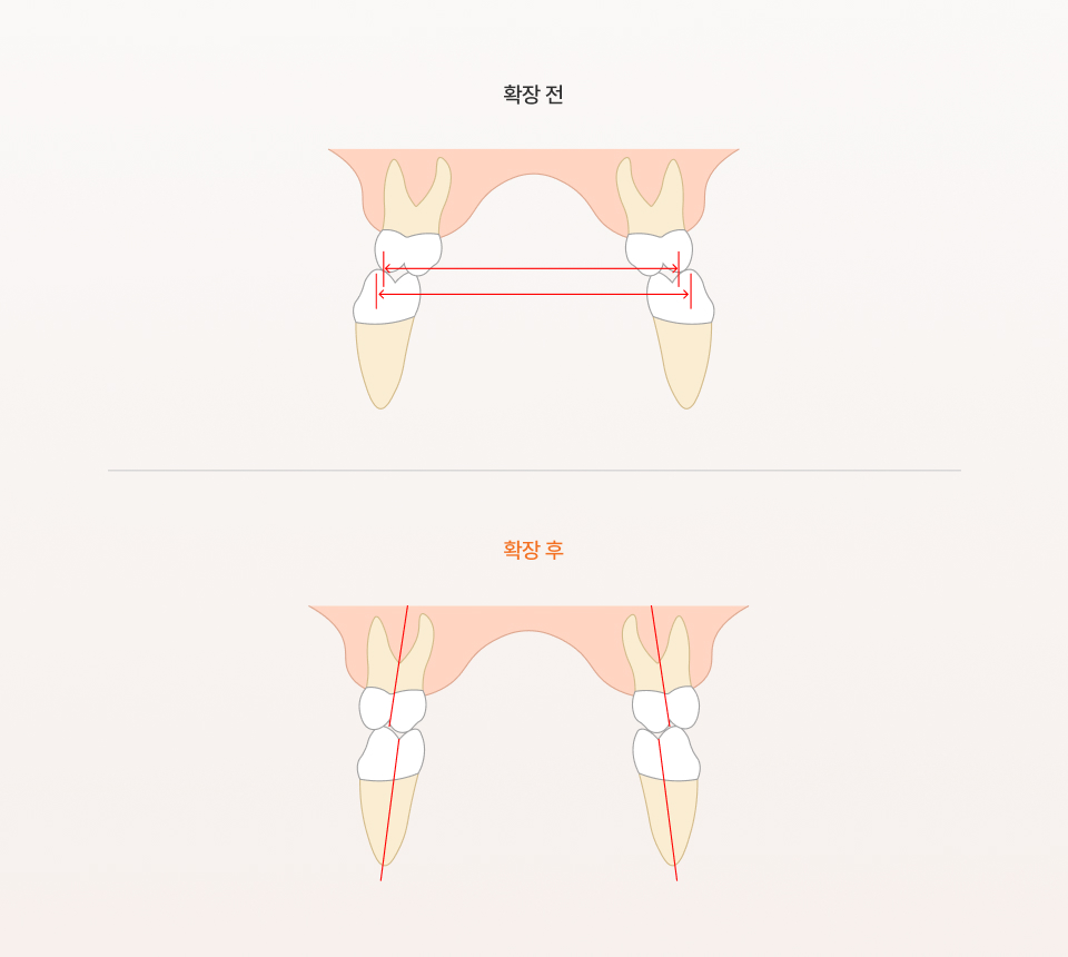 악궁 확장 도해