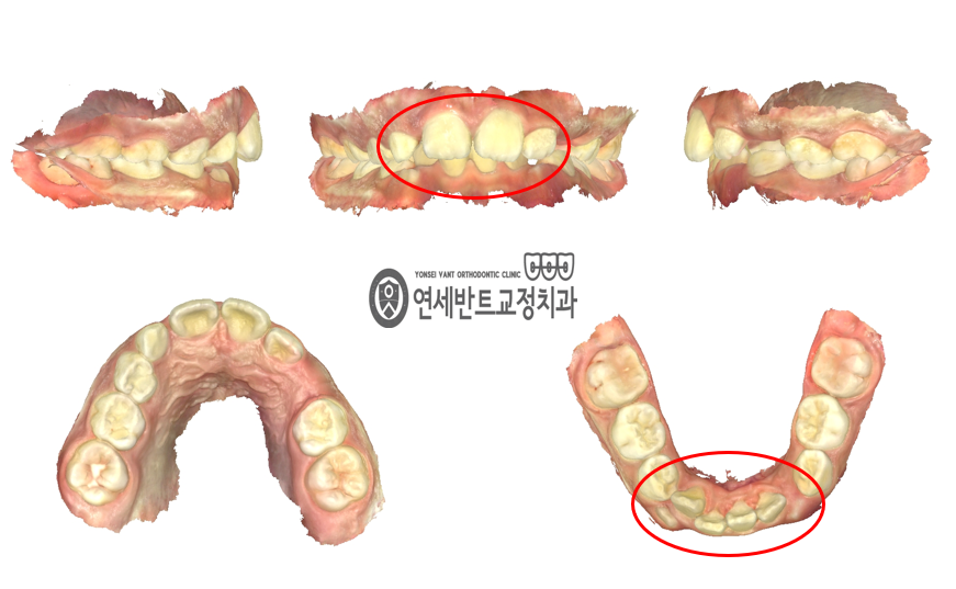 3D 치열 스캔