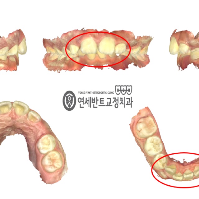인비절라인