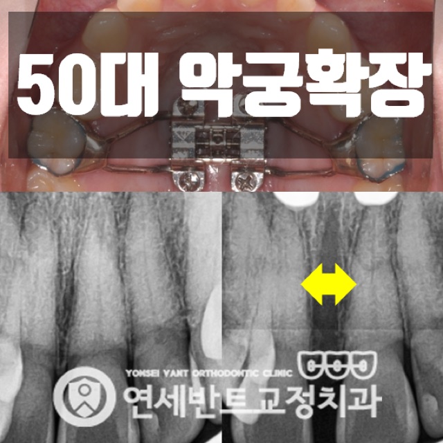 인천 남동구교정치과 50대 악궁확장