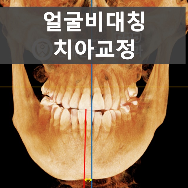 안면비대칭