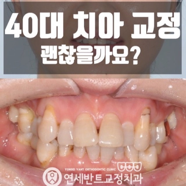 인천 송도교정치과 40대 50대 치아교정 가능할까