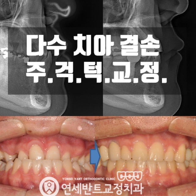 인천주걱턱교정 수술없이도 가능한가요?