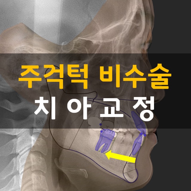 연수동 교정치과 주걱턱 치료에서 알아야 할 핵심 기준