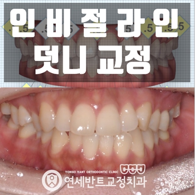 인천 구월동치아교정 투명하게 진행해요
