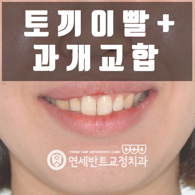 토끼앞니와 과개교합, 인천 치아교정으로 접근하기