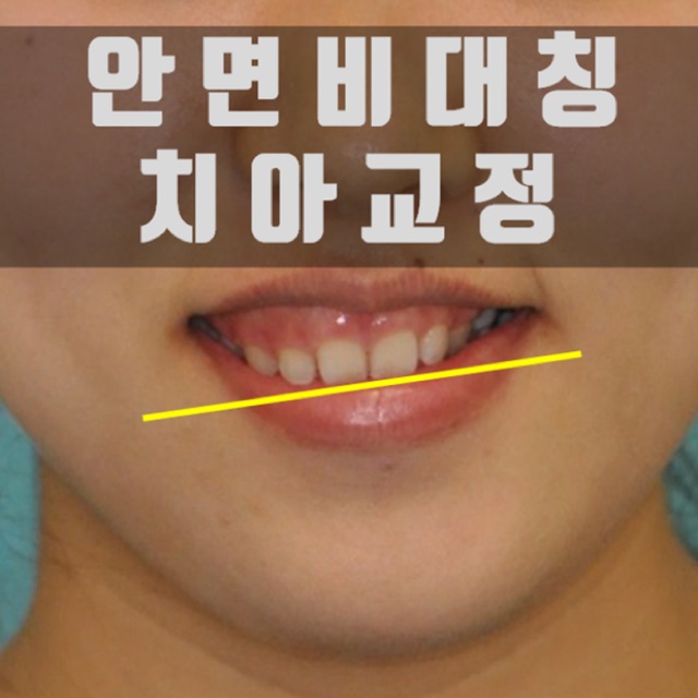 인천구월동교정 치과에서 알아보는 안면비대칭 과정