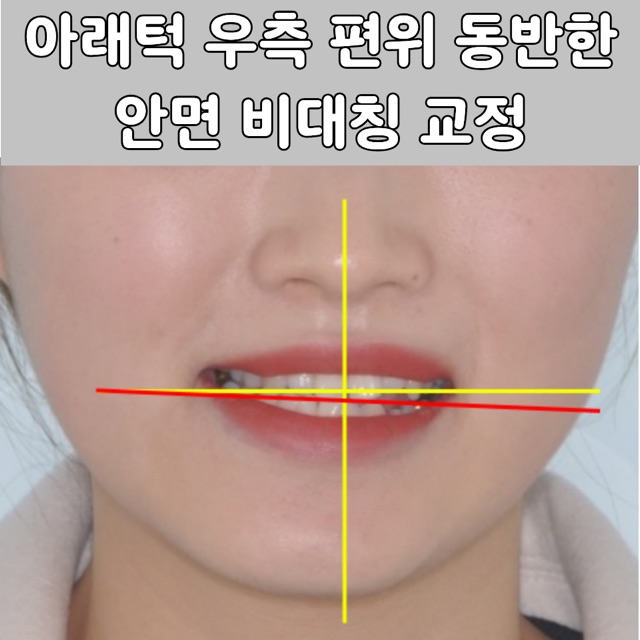 주안 치아교정으로 보는 성인 안면비대칭 비수술 접근